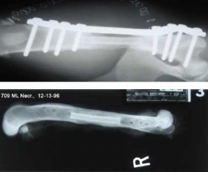 McGee's Osteoceramic inducing bone regeneration.